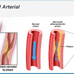 Peripheral-Arterial-Disease
