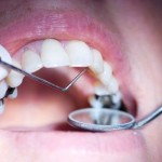 Fighting-Tooth-Decay
