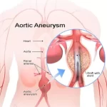 aortic-aneurysm