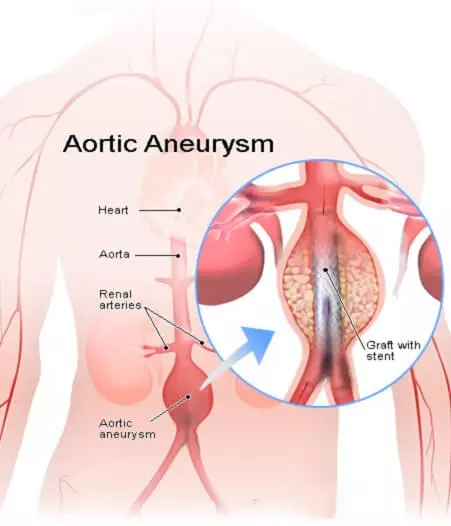 What are the Symptoms of Aortic Aneurysm?