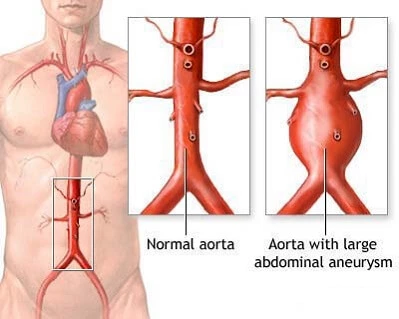 symptoms-of-aortic-aneurysm