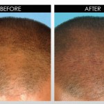 Derma-Rollers-for-Hair