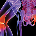 hip-and-knee-replacements