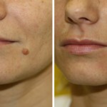 skin-tags