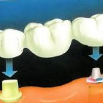dental-implant-expert