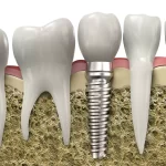 Dental-Implants