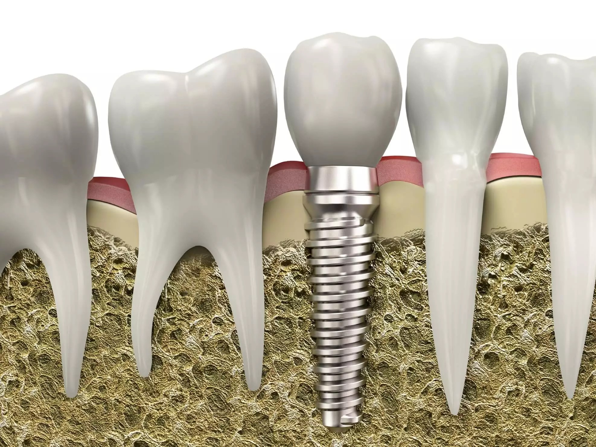 Dental Implants – How Do They Work?