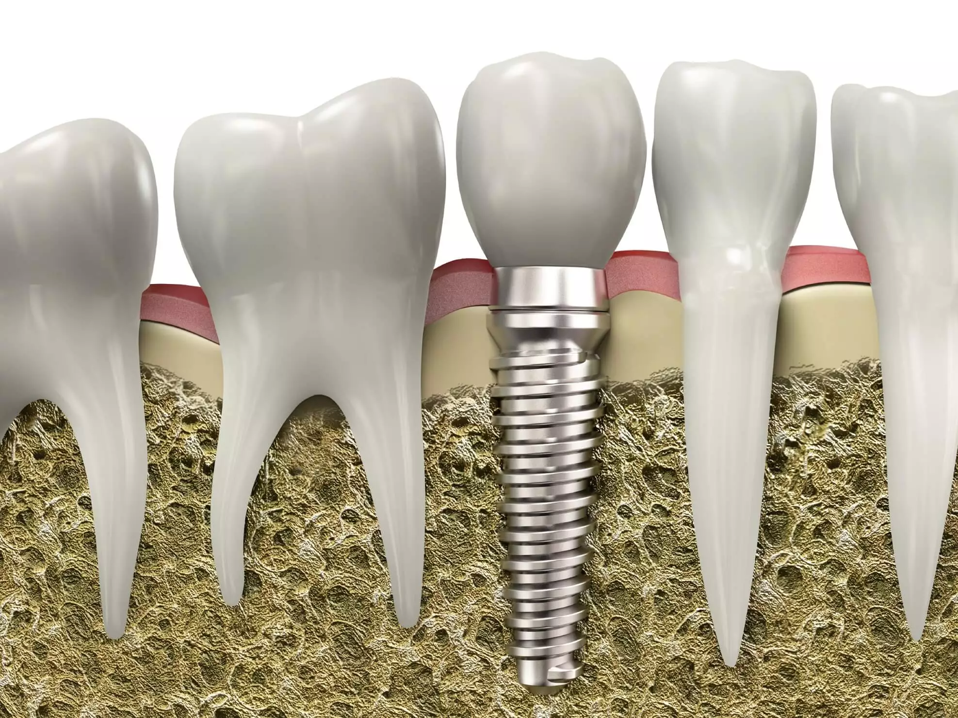 Dental-Implants