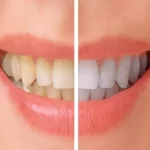 Teeth-Whitening-Methods