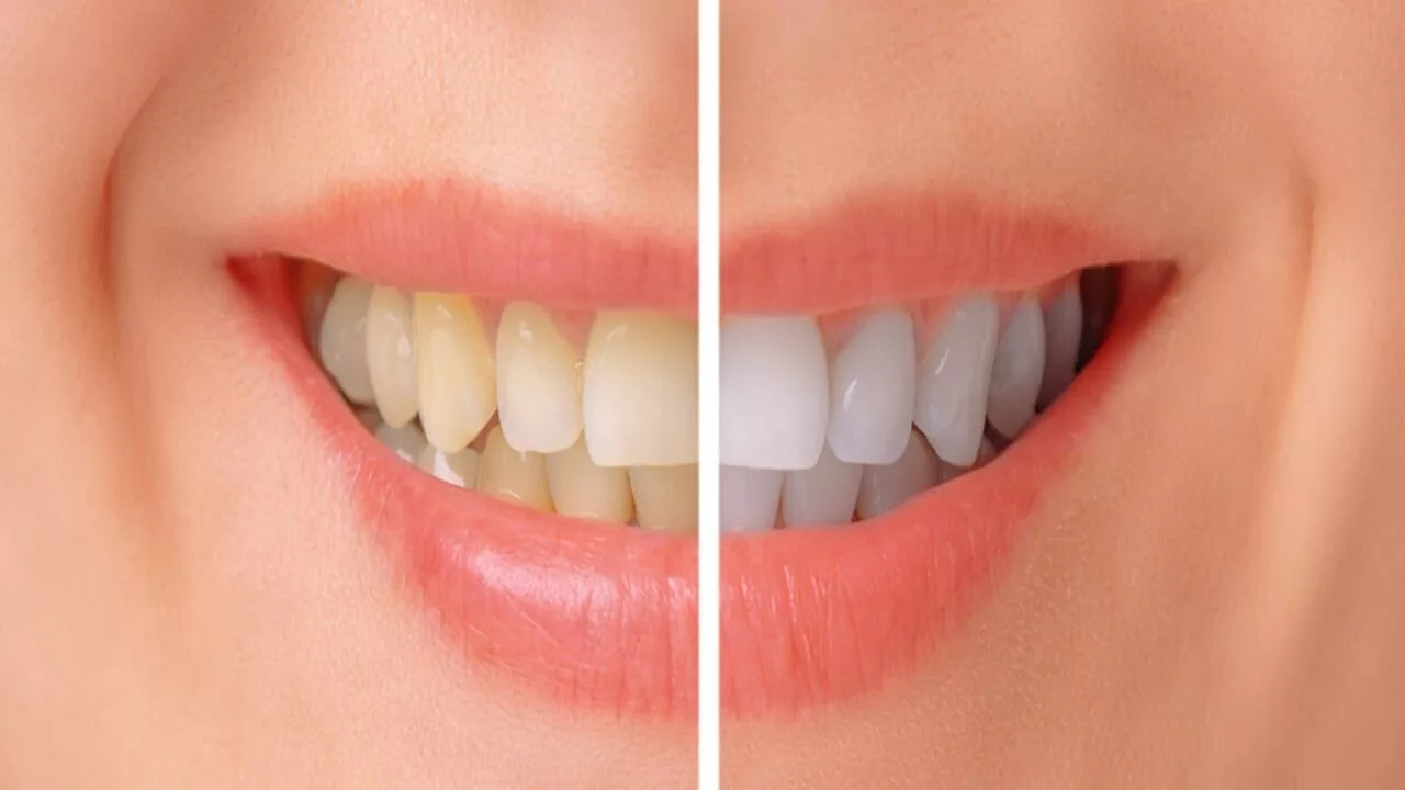 Top 5 Home Teeth Whitening Methods