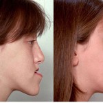 Jaw-Surgery