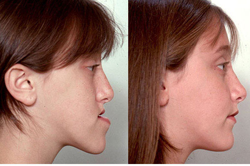 Jaw-Surgery