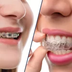 Orthodontic-Treatment