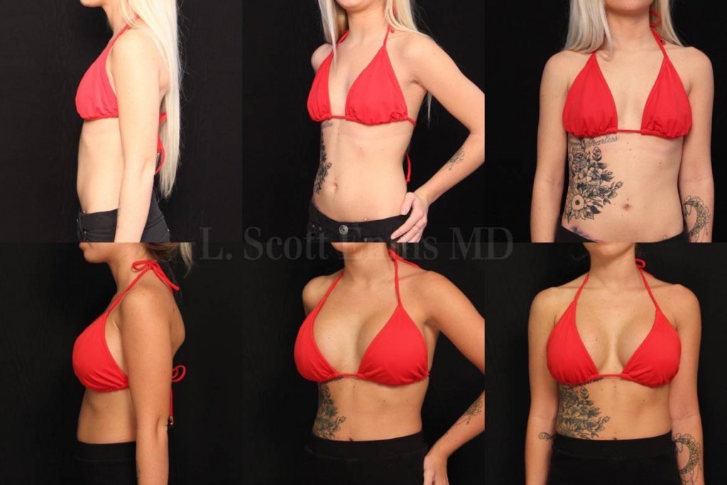 breast augmentation