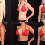 breast augmentation