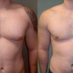 Liposuction-The Perfect Solution to Eliminate Stubborn Fat Deposits