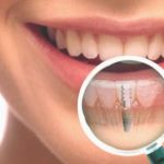 Dental Implants and Preventing Bone Loss