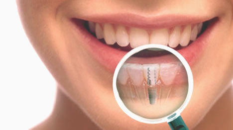 Dental Implants and Preventing Bone Loss