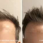 Hair-Transplant