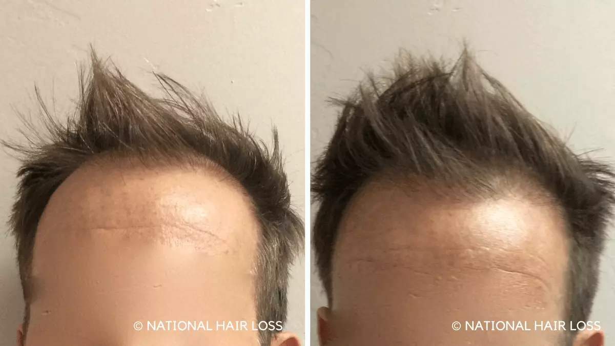 Can You Go Bald After Hair Transplant