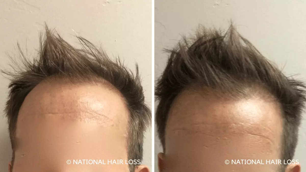 Hair-Transplant