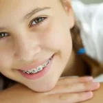 6-Key-Braces-Mistakes-that-You-Need-to-Avoid
