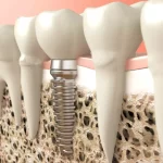 Dental-Implant-Aftercare-Tips
