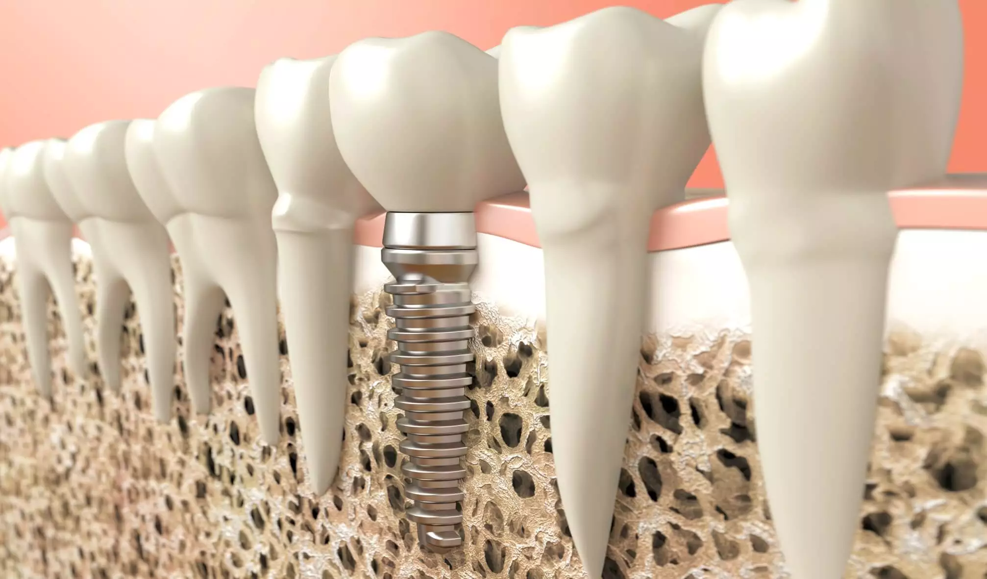 5 Crucial Dental Implant Aftercare Tips