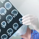 The 5 Differences Between Aneurysm And Stroke