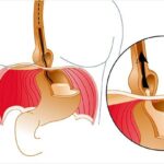 Hiatus Hernia Cough