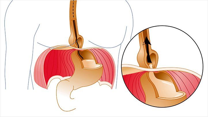 Hiatus Hernia Cough