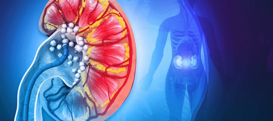 Kidney Stone Surgery Kidney Stone Surgery