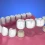 Post-Op Wisdom Teeth Recovery Guide: Pain, Swelling & Diet