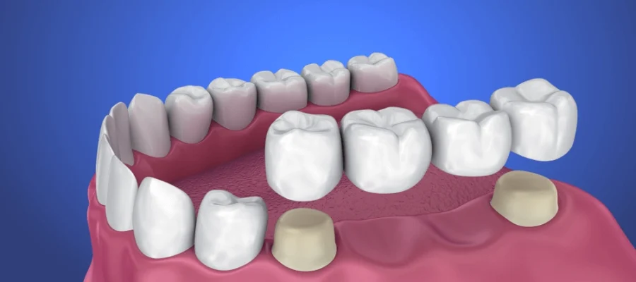 Wisdom Teeth Recovery