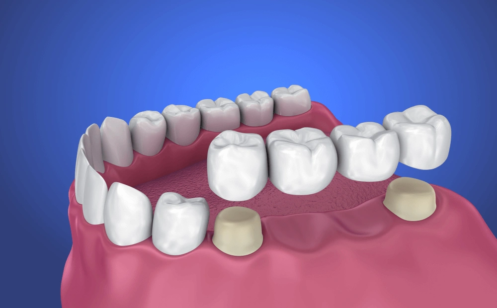 Wisdom Teeth Recovery Wisdom Teeth Recovery