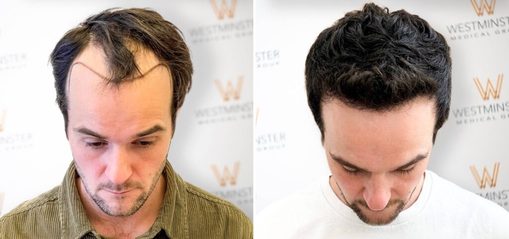 Hair Transplant London
